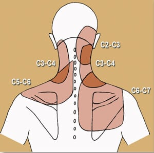 Figure 9. Facet and Referral Map. A well-designed study by Bogduk and Marsland tracked and labeled painful facet referral patterns. The authors found that most head and neck pain stems from C 2-3 while shoulder/arm pain referred from C 5-6. Prolonged joint blockage facilitates (tightens) or inhibits (weakens) associated muscles in each of the above areas often contributing to painful forward head postures. Reprinted with permission from the journal Spine, 1988.