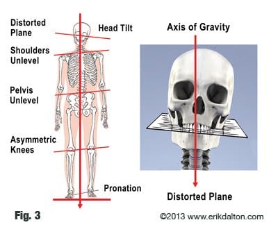A functional scoliosis is essentially a postural adaptation to an imbalance in one’s base of support. Most of us think of the feet as our only base of support, but what about the sacral base and occipitoatlantal joints? When unlevel, the head and spine must make necessary adjustments. These primary bases of support may trigger ascending or descending postural adaptions patterns throughout the kinetic chain (Fig. 3).