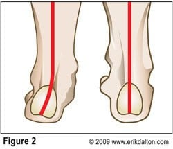 If the navicular and cuneiforms resist this spring test and the mid-foot appears flat, the arch is pronated. As we recall, the most common lower extremity asymmetry is foot pronation. Weakness of tibialis anterior, peroneus longus and the plantar aponeurosis (Stirrup Spring System), results in a valgus subtalar joint (STJ) accompanied by a dropped navicular bone (Fig. 2).