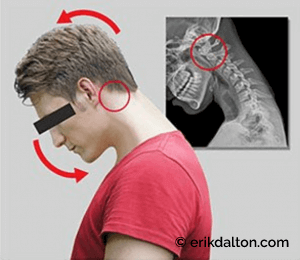 O-A joint locked in flexion from text-neck forward head posture.
