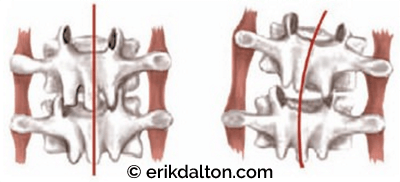 Figure 4: Facet joints (right) lock closed during prolonged right cervical side bending. Note the reflex spasm in the intertransversarii muscle. Adapted from the Tom Bowman with permission.